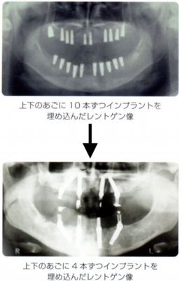 オールオン４